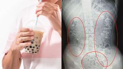 Nastolatka zgłosiła się do lekarza z bólem brzucha. To skutek picia bubble tea