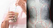 Nastolatka zgłosiła się do lekarza z bólem brzucha. To skutek picia bubble tea