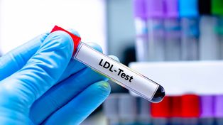 To nie tylko zły cholesterol. Odkryli, co niszczy tętnice
