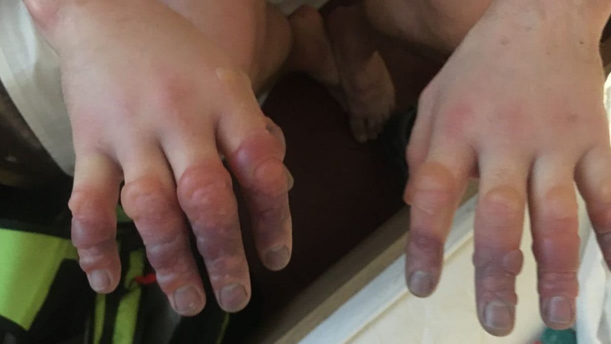 Jeden z turystów odmroził sobie dłonie