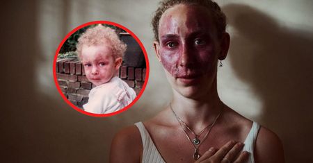 Lekarze poparzyli jej twarz. Miała wtedy dwa lata