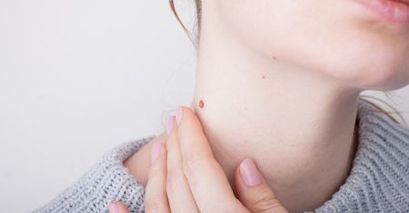 Usuwanie brodawek i włókniaków