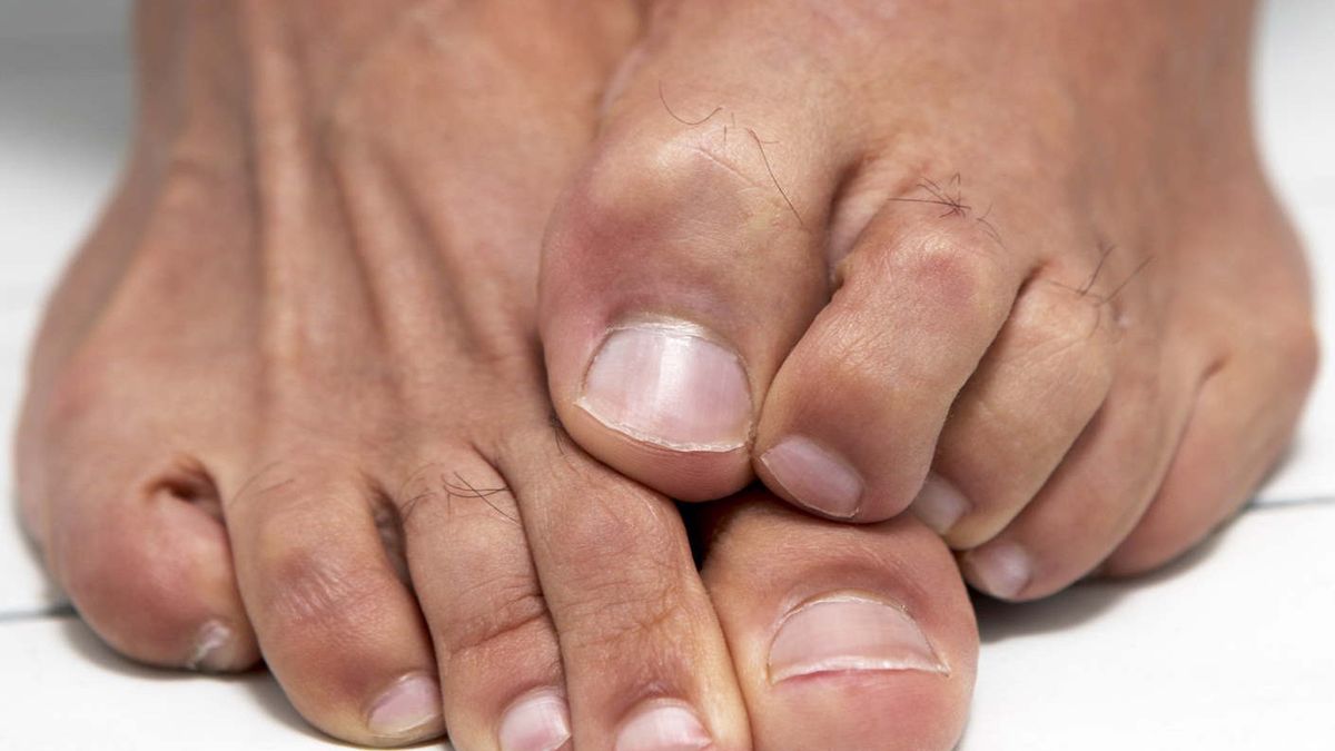 Objaw pojawia się na stopach. Nie lekceważ