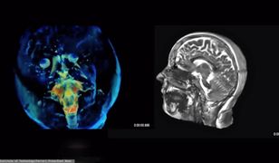 Mrożące odkrycie badaczy. Wykryli cząstki w ludzkim mózgu