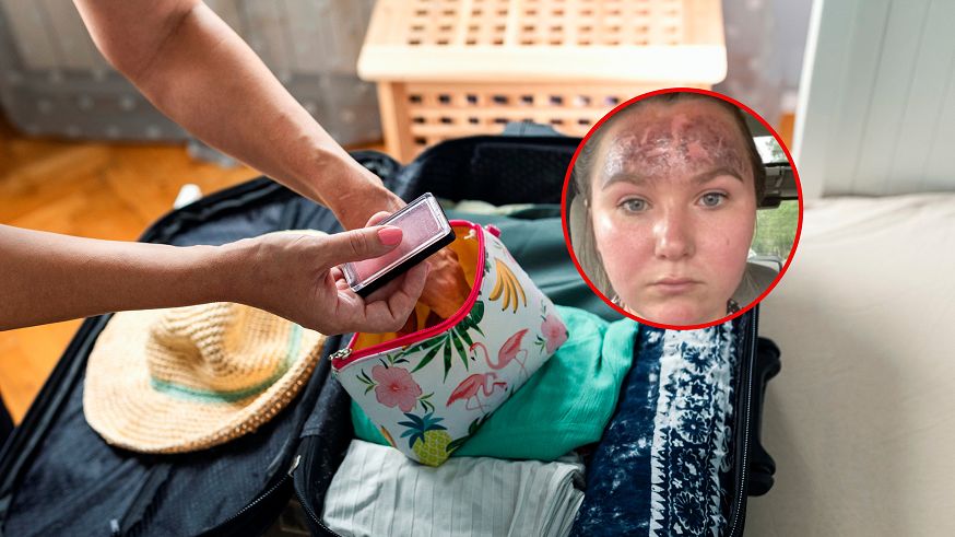 Nie sprawdziła daty ważności na kremie z filtrem. Z urlopu wróciła z fatalnymi poparzeniami
