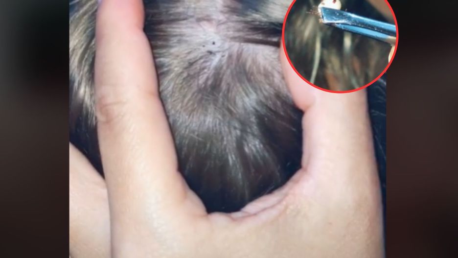 Pokazała, jak wyciąga kleszcza z głowy dziecka. Najgorszy jest dźwięk