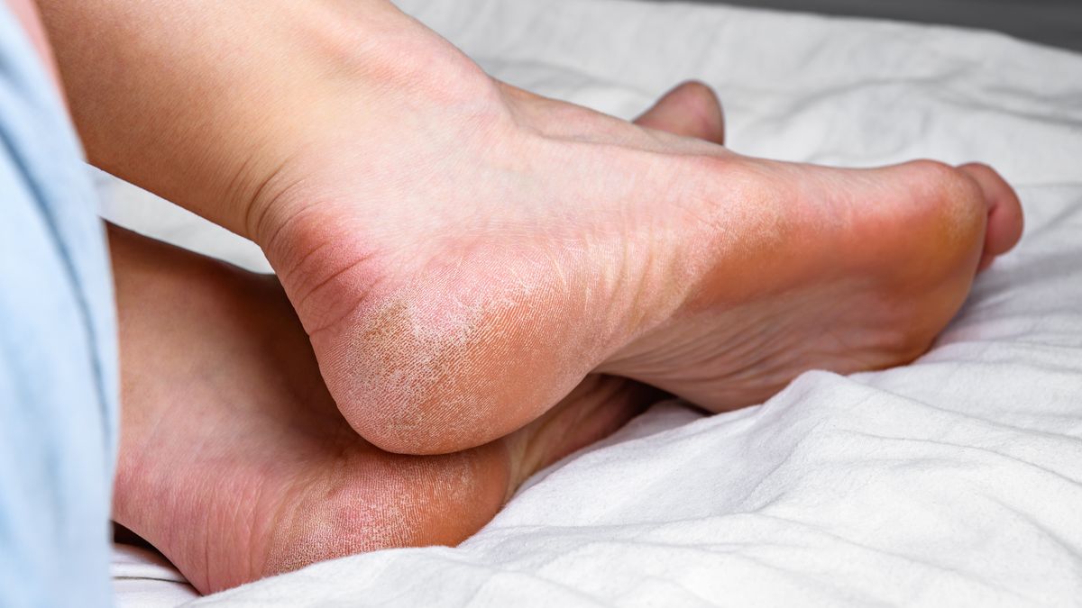 Jak poradzić sobie z suchymi piętami? 