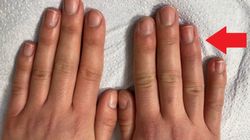 Lekarka pokazała, jak wyglądają "covidowe palce". Nastolatek trafił na SOR
