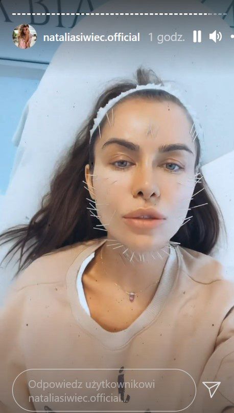Natalia Siwiec z twarzą NAKŁUTĄ IGŁAMI relacjonuję wizytę w klinice medycyny estetycznej