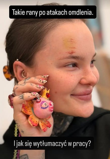 Monika Miller pokazała obrażenia twarzy 