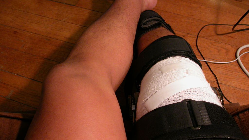 W przypadku niektórych urazów stawu kolanowego konieczne jest unieruchomienie nogi