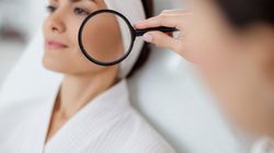 Wybroczyny na twarzy - wygląd, przyczyny, rozpoznanie i leczenie