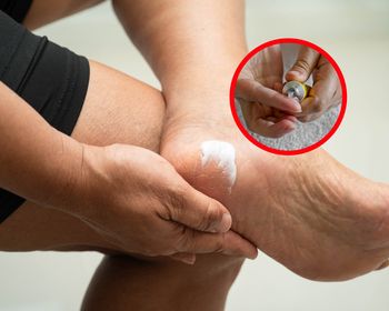 Ratuje popękane pięty. Niedroga maść z apteki działa jak plaster