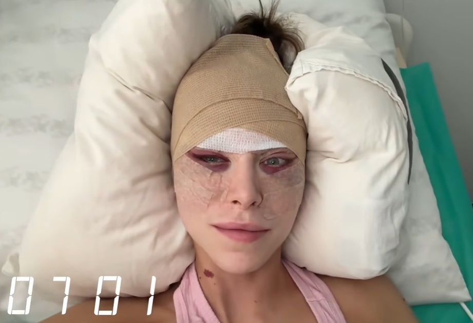 Julia von Stein po drugiej operacji