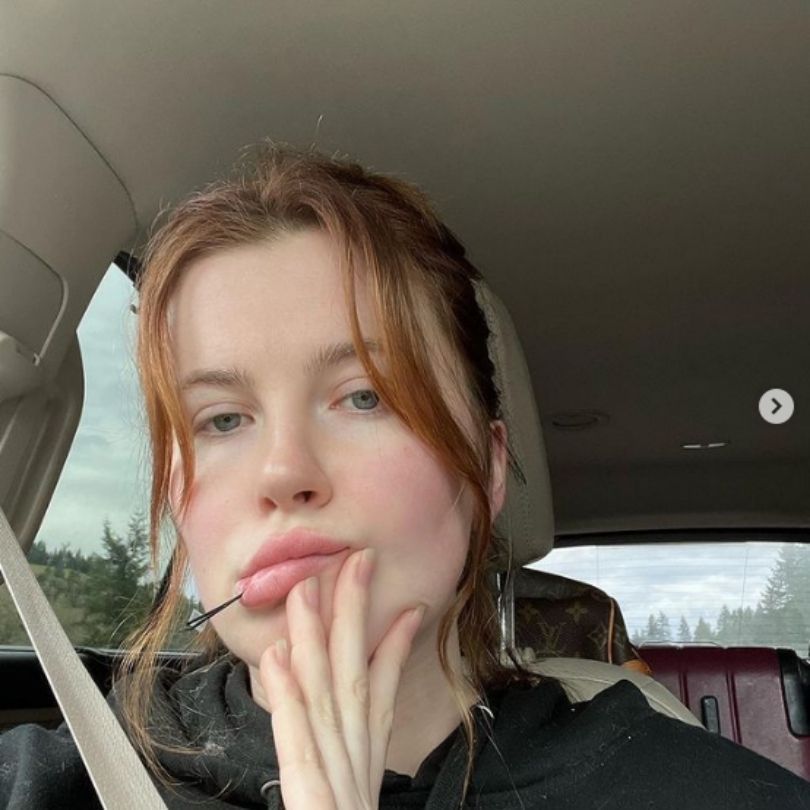Ireland Baldwin tłumaczy się z zabiegu podbródka