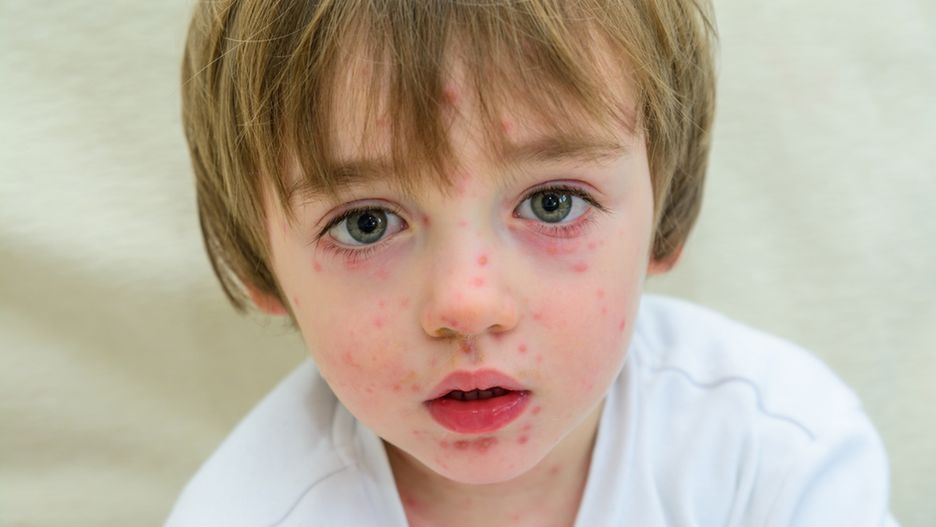 Czy grozi nam epidemia ospy wietrznej? 