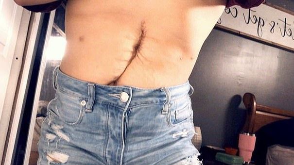 Gina Arnold potrzebowała 20 operacji brzucha