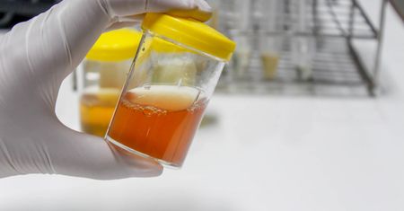 Albuminuria - przyczyny, objawy i leczenie