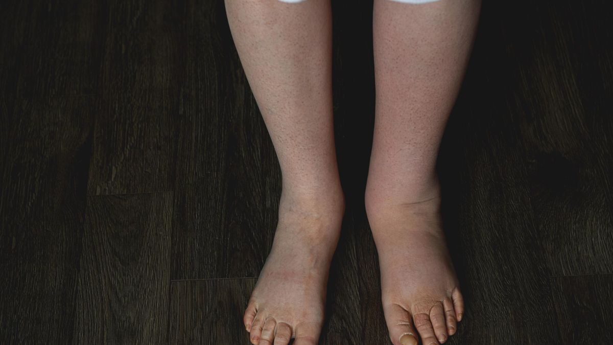 Znak, że układ limfatyczny szwankuje. Różnica w wyglądzie skóry ujawni prawdę