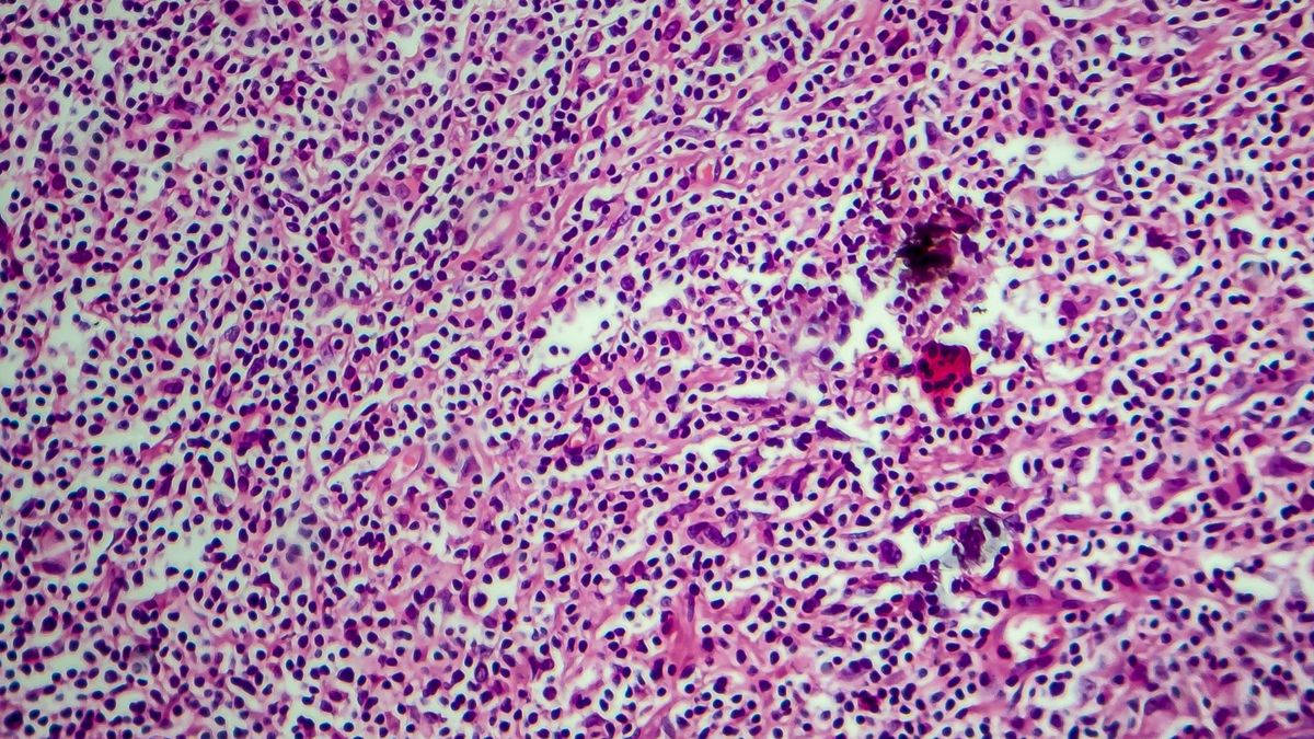 Ziarnica złośliwa nazywana również chłoniakiem Hodgkina to choroba nowotworowa, obejmująca układ chłonny.