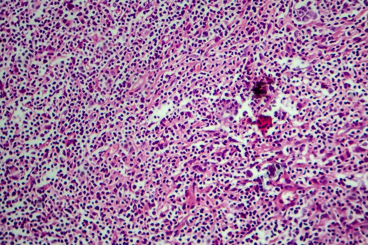 Chłoniak Hodgkina (ziarnica złośliwa) - przyczyny, objawy, diagnostyka, leczenie, rokowania