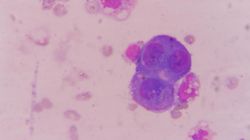 Rokowania nowotworu kości - kostniakomięsak, chrzęstniakomięsak, mięsak Ewinga