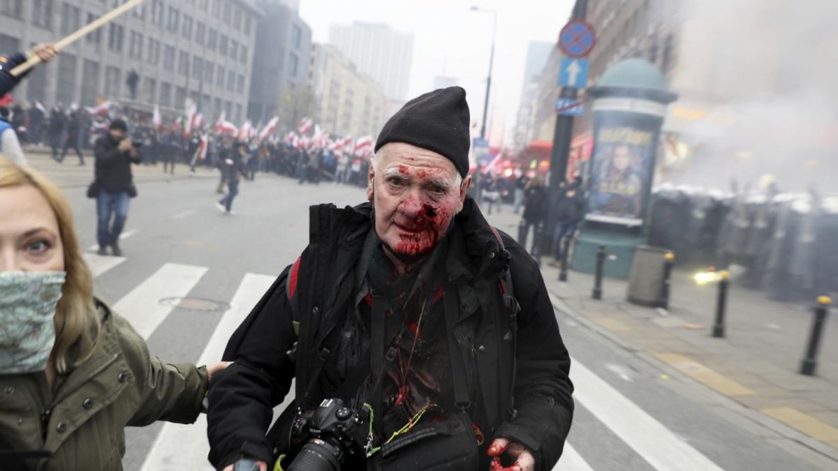 Tomasz Gutry z "Tygodnika Solidarność" został wczoraj postrzelony w twarz podczas Marszu Niepodległości. 