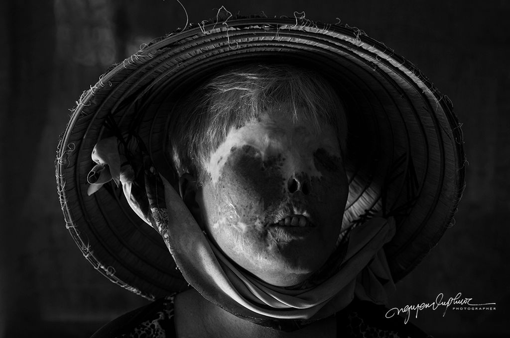 Nguyen Vu Phuoc żyje i fotografuje w Wietnamie. Zajmuje się tym od 1993 roku. Po skończeniu swojego wieloletniego projektu ”Labor of love a mother's journey” postanowił opowiedzieć historię ludzi, których spotkała tragedia większa niż śmierć – bolesna, zostawiająca piętno na całe życie. Mowa o samosądach w formie oblewania żrącym kwasem.