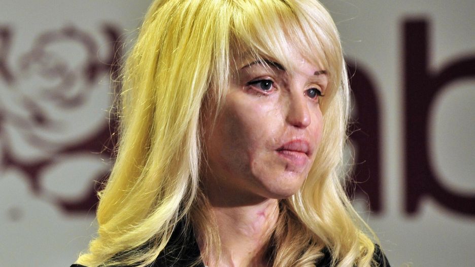 13 lat temu została oblana kwasem. Katie Piper dotychczas przeszła 400. operacji