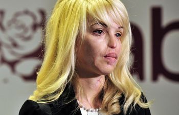 17 lat temu została oblana kwasem. Tak wygląda po latach
