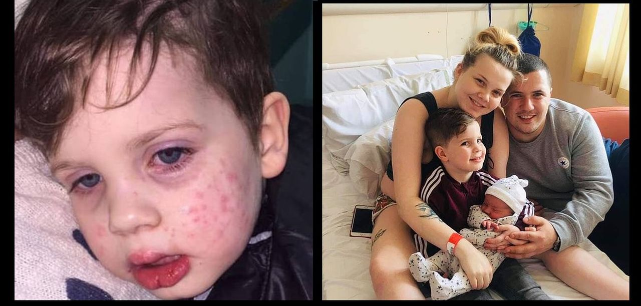 Wirus opryszczki groźny dla dzieci. To "pocałunek śmierci"