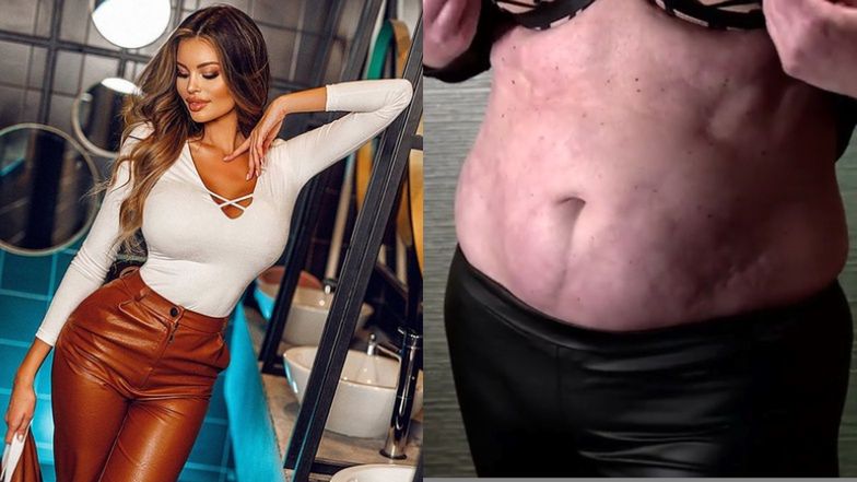 Justyna Gradek reklamuje lekarza oskarżanego o nieudane operacje plastyczne