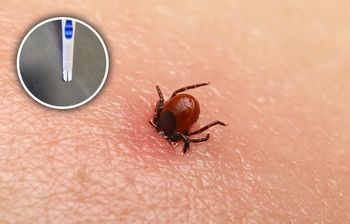 Jak usunąć kleszcza? Pamiętaj o ważnej zasadzie