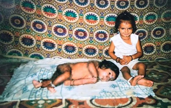 Lalit od urodzenia cierpi na hipertrychozę