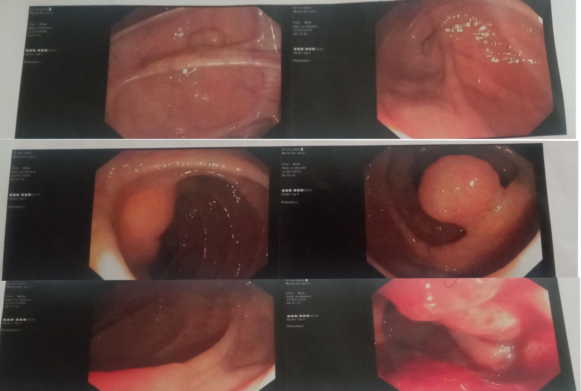 Kolonoskopia ujawniła niepokojące zmiany