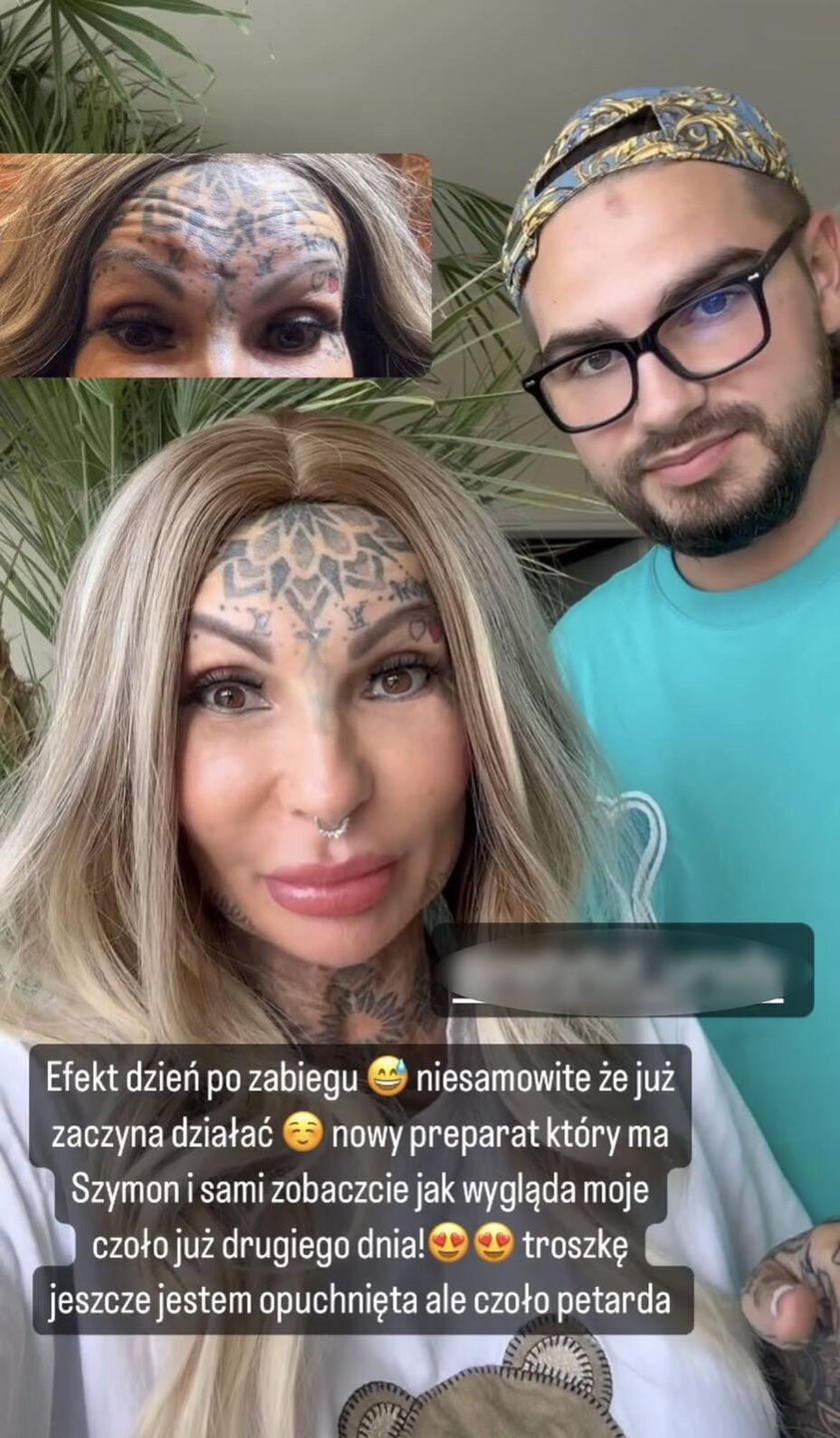 Adrianna Eisenbach chwali się kolejnym zabiegiem upiększającym