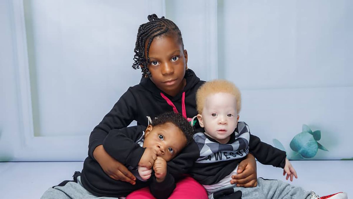 Zdjęcia niecodziennych bliźniaków. Jeden jest albinosem 1