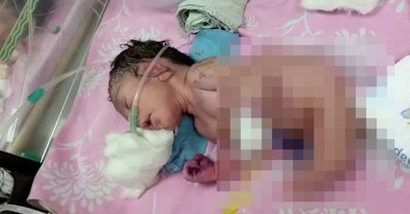 "Syreni ogon" zamiast nóg. Niesamowite narodziny w Indiach