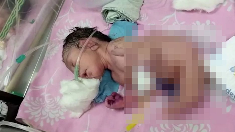 Noworodek ma zrośnięte nogi, które tworzą strukturę przypominającą róg