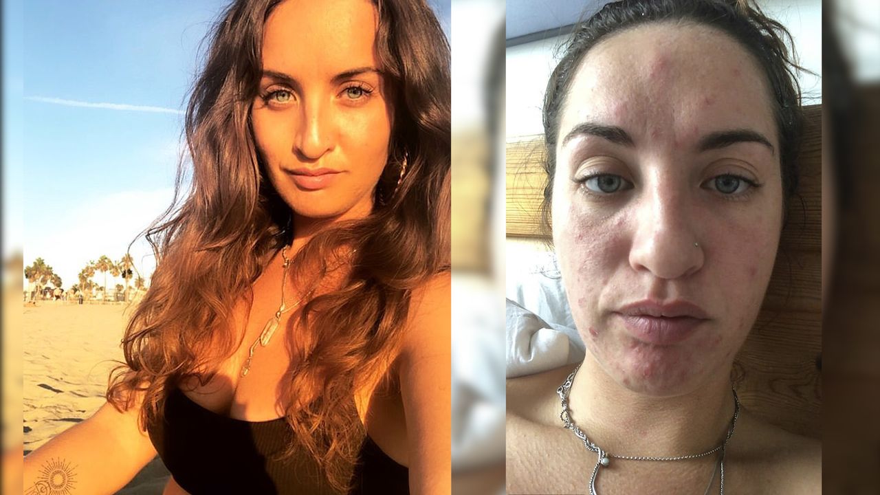 Przez pleśń w mieszkaniu poważnie zachorowała (WIDEO)