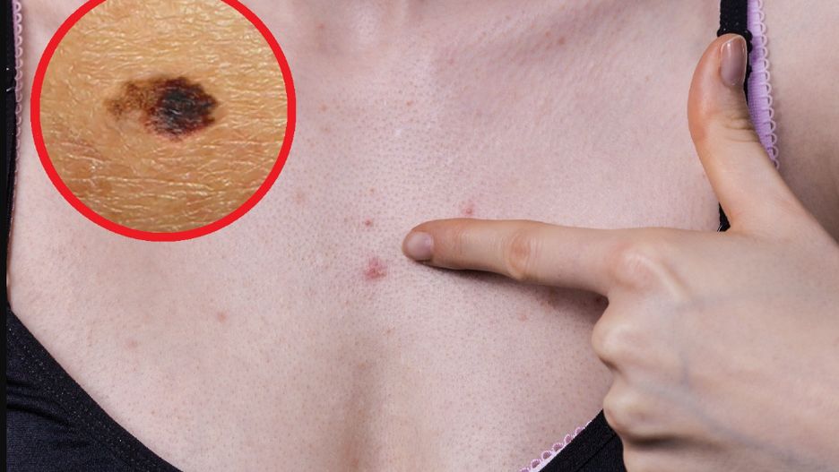 To zwiastun groźnego raka. Charakterystyczny objaw widać na skórze