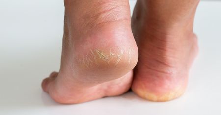 Skuteczna maść na żółte, pękające pięty. Kupisz ją za kilka złotych