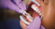 Niewidoczny aparat Invisalign - zalety, przebieg leczenia, przeciwwskazania
