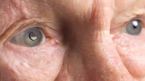 Miniaturowy teleskop wszczepiany do oka 1