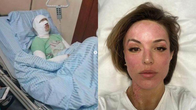 7 lat temu została oblana kwasem