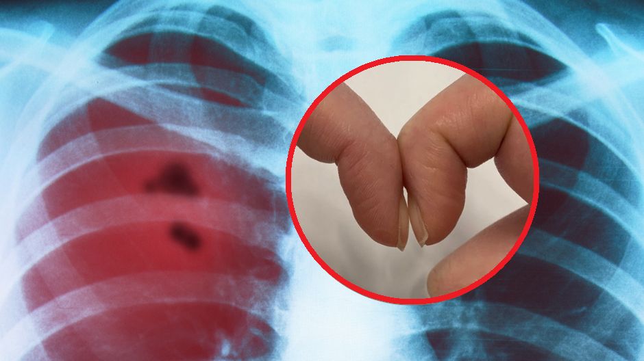 Jak wykonać prosty test na raka płuc?