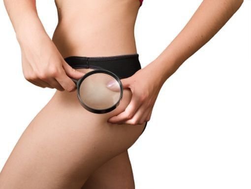 Jak pozbyć się cellulitu? List do Dermatologa