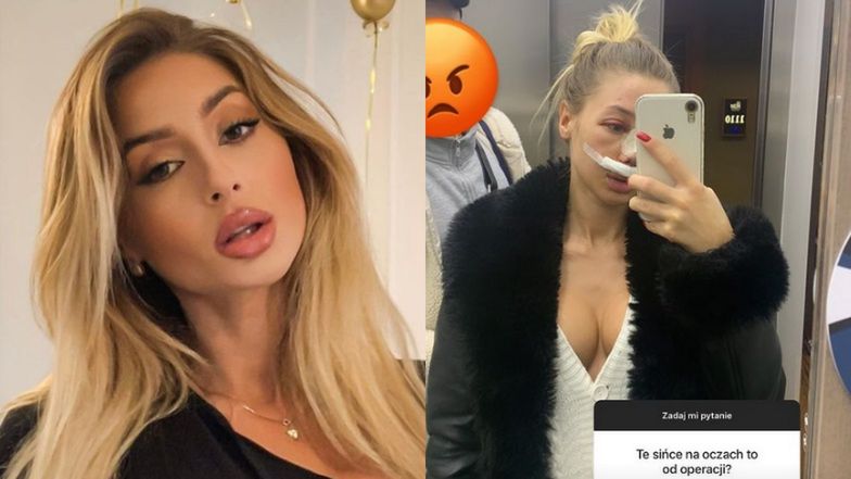 Kinga Zapadka zoperowała sobie nos w Turcji! "Pierwsze doby były okropne. Zero snu, ból gardła i zębów" (ZDJĘCIA)