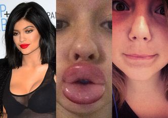 Ofiary powiększania ust "na glonojada"... Chciały być jak Kylie Jenner!