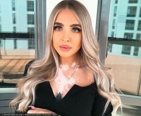 Od lat cierpi na bielactwo. Najpierw chciała je ukryć, teraz się nim chwali